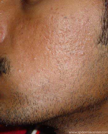 Acne-After